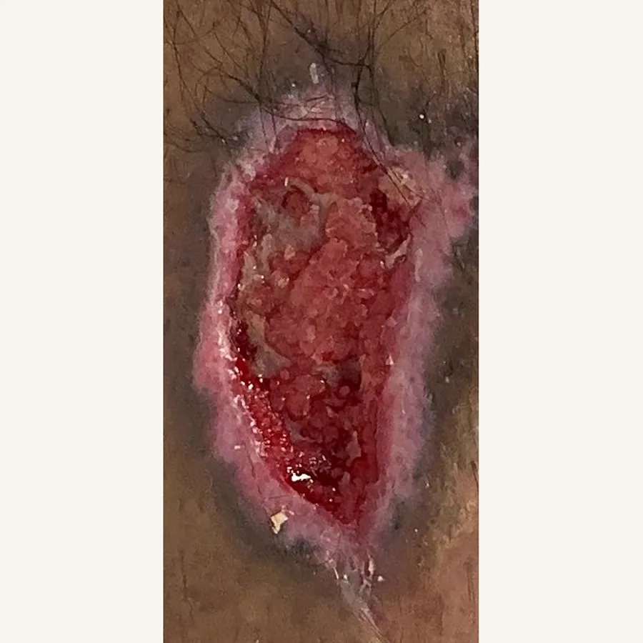 Clinical photograph of a trauma-related leg wound at visit 1, HKL-67