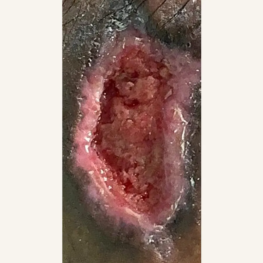 Clinical photograph of a trauma-related leg wound at visit 2, HKL-67