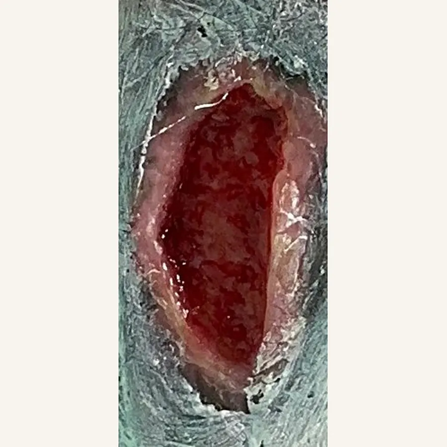 Clinical photograph of a trauma-related leg wound at visit 3, HKL-67