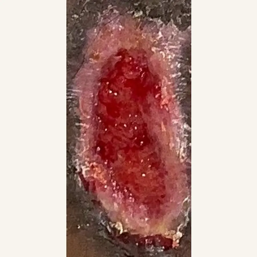Clinical photograph of a trauma-related leg wound at visit 4, HKL-67