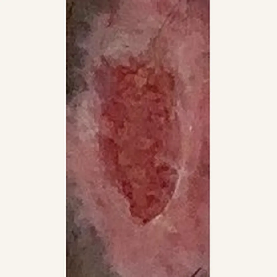 Clinical photograph of a trauma-related leg wound at visit 5, HKL-67