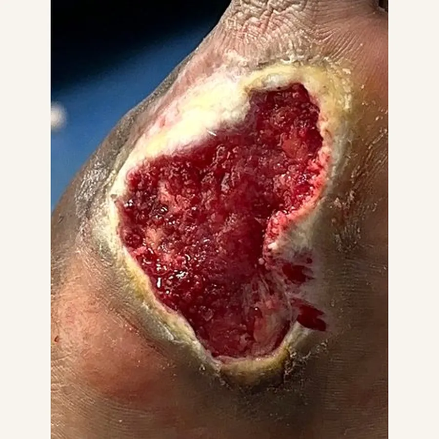 Clinical photograph of a diabetic plantar wound at visit 1, HKL-68