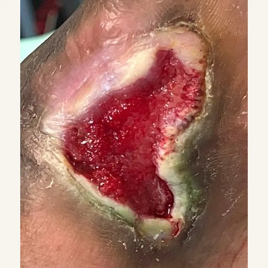 Clinical photograph of a diabetic plantar wound at visit 2, HKL-68