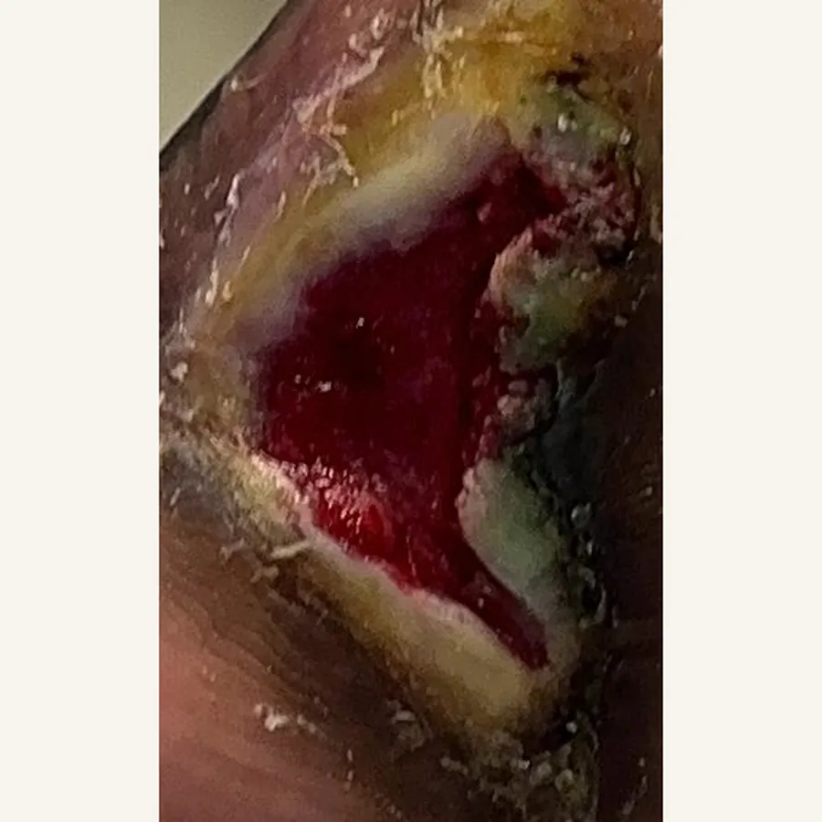 Clinical photograph of a diabetic plantar wound at visit 3, HKL-68
