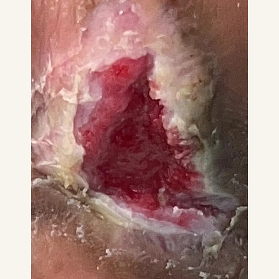 Clinical photograph of a diabetic plantar wound at visit 4, HKL-68