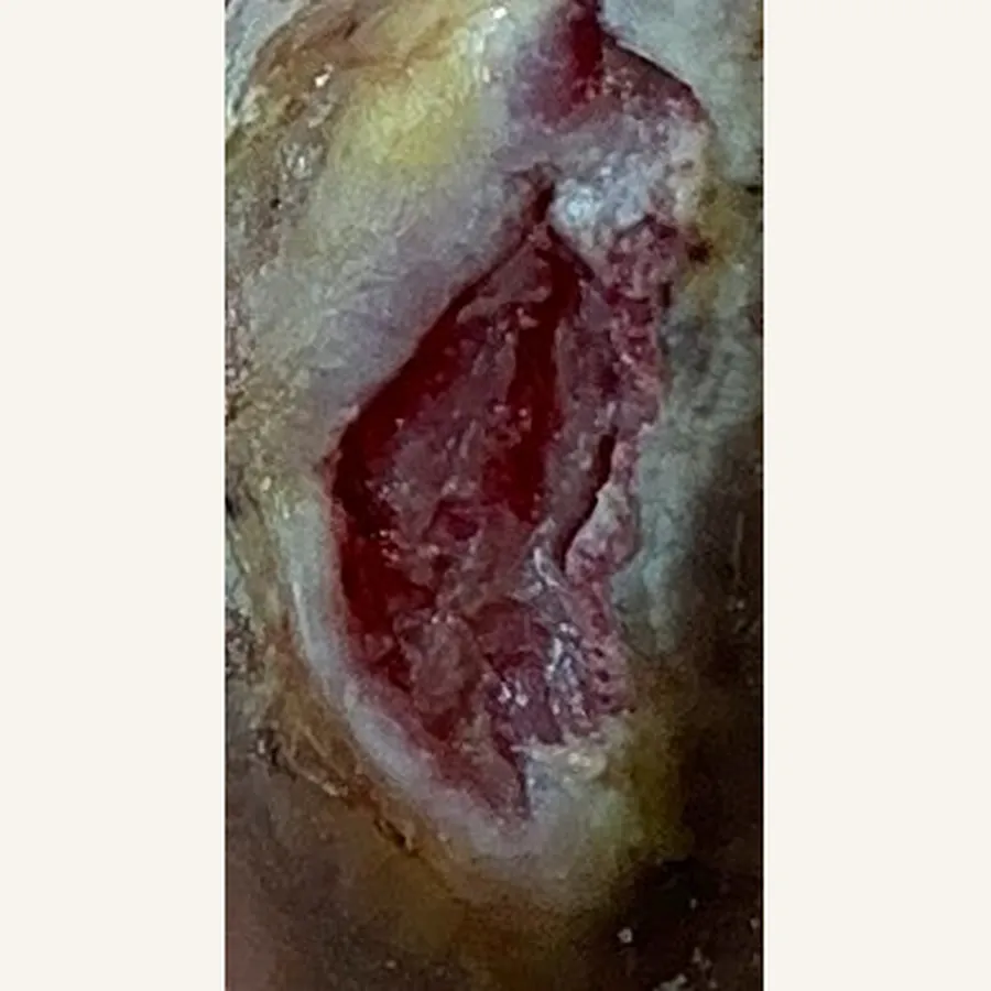 Clinical photograph of a diabetic plantar wound at visit 5, HKL-68