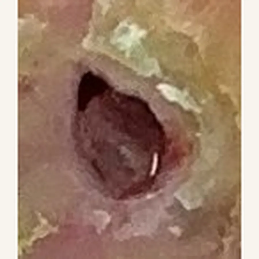 Clinical photograph of a diabetic plantar wound at visit 1, HKL-69