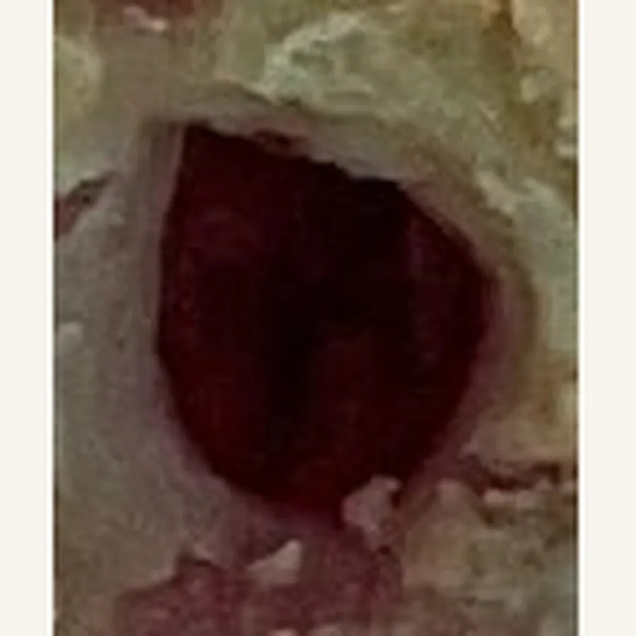 Clinical photograph of a diabetic plantar wound at visit 2, HKL-69