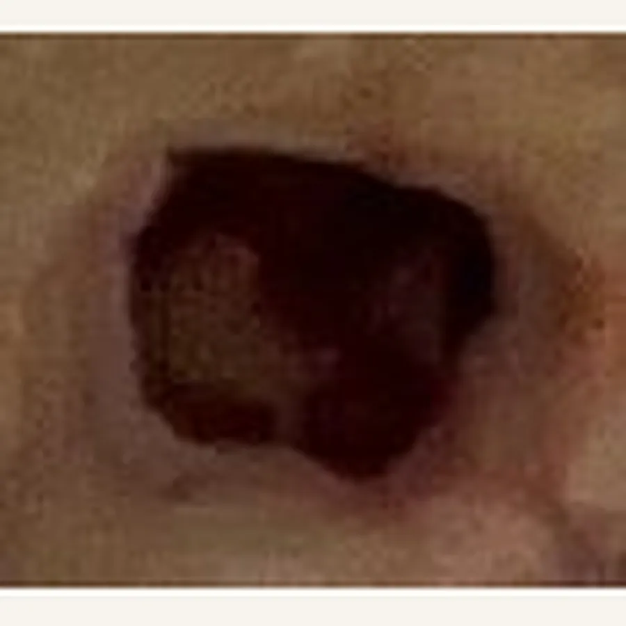 Clinical photograph of a diabetic plantar wound at visit 3, HKL-69