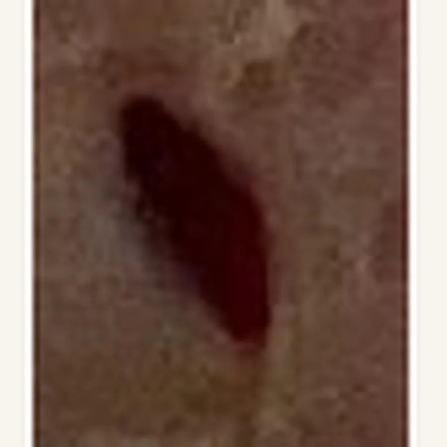 Clinical photograph of a diabetic plantar wound at visit 4, HKL-69