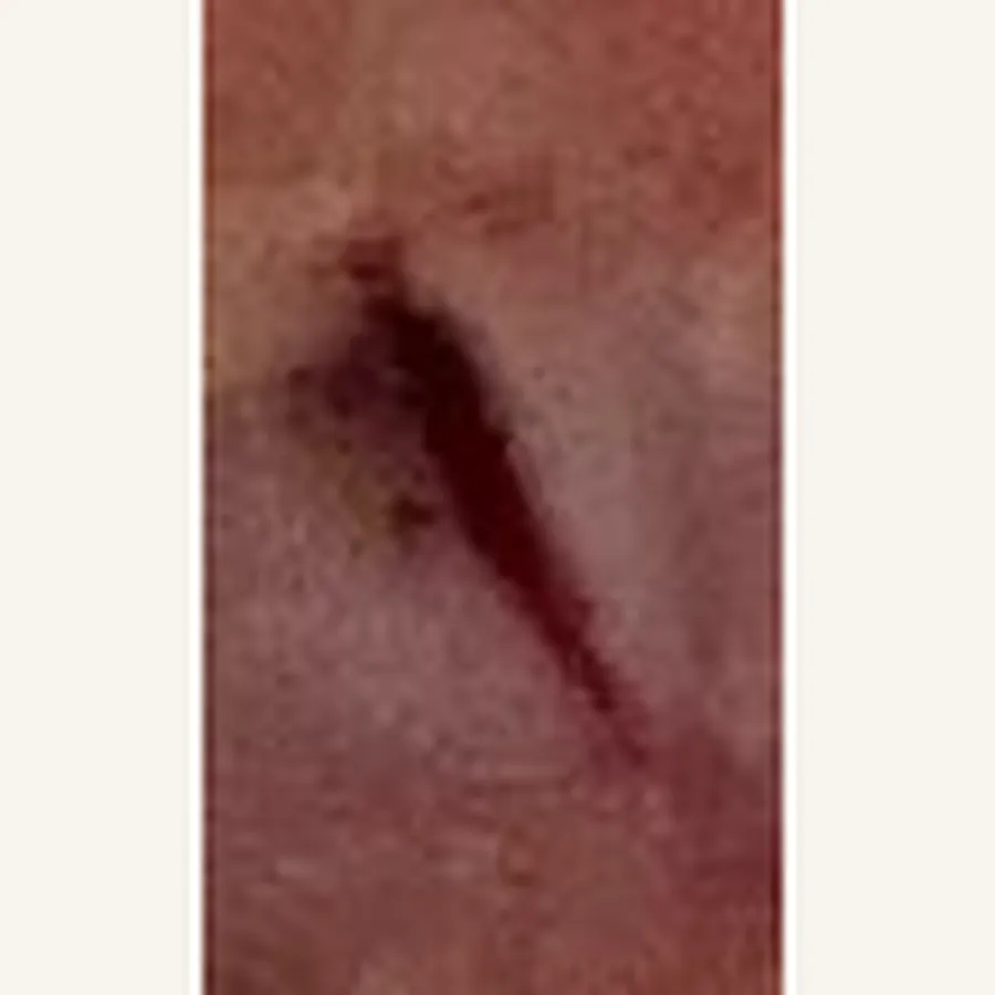 Clinical photograph of a diabetic plantar wound at visit 5, HKL-69
