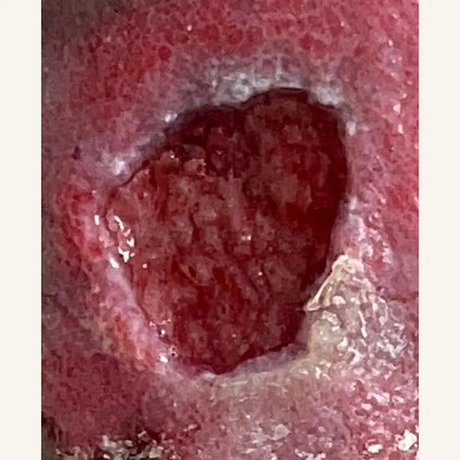 Clinical photograph of a diabetic calf wound at visit 1, HKL-70