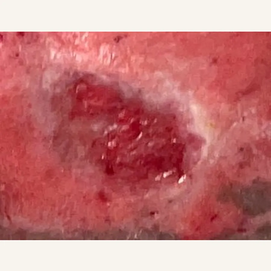 Clinical photograph of a diabetic calf wound at visit 2, HKL-70