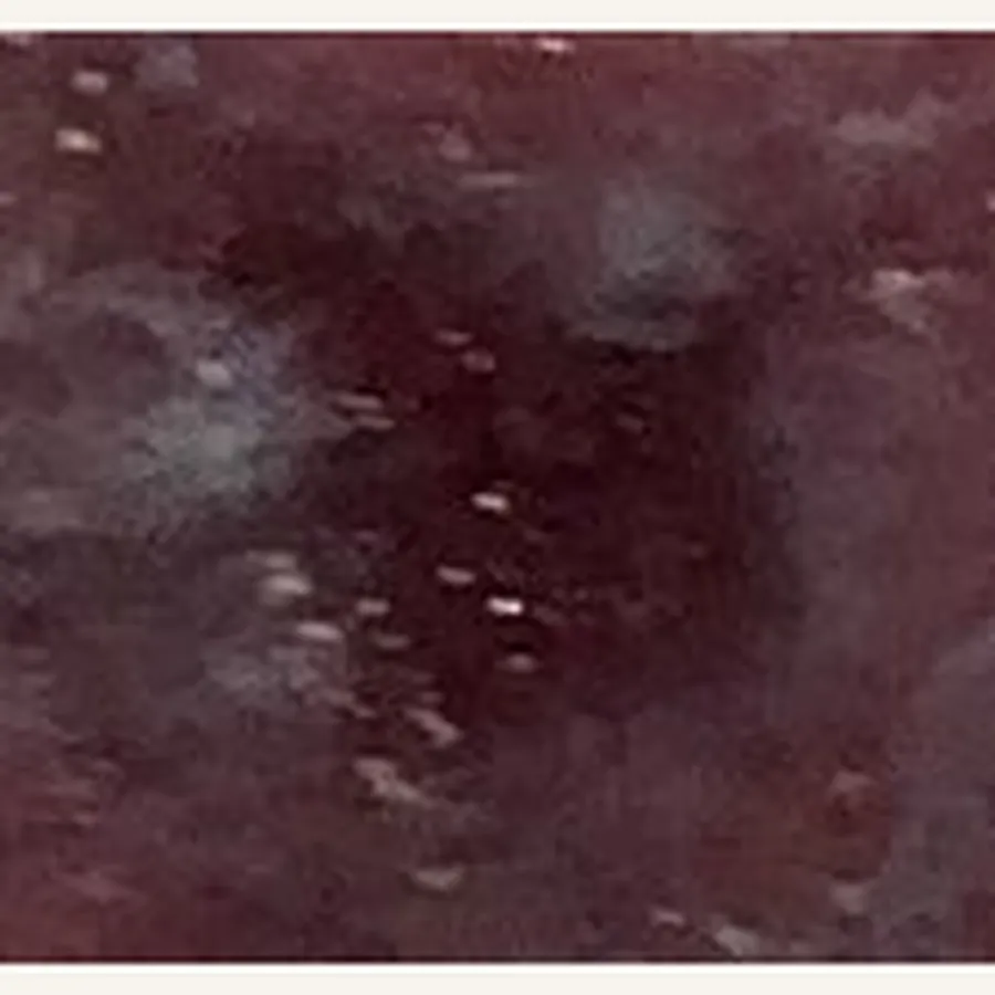 Clinical photograph of a diabetic calf wound at visit 3, HKL-70