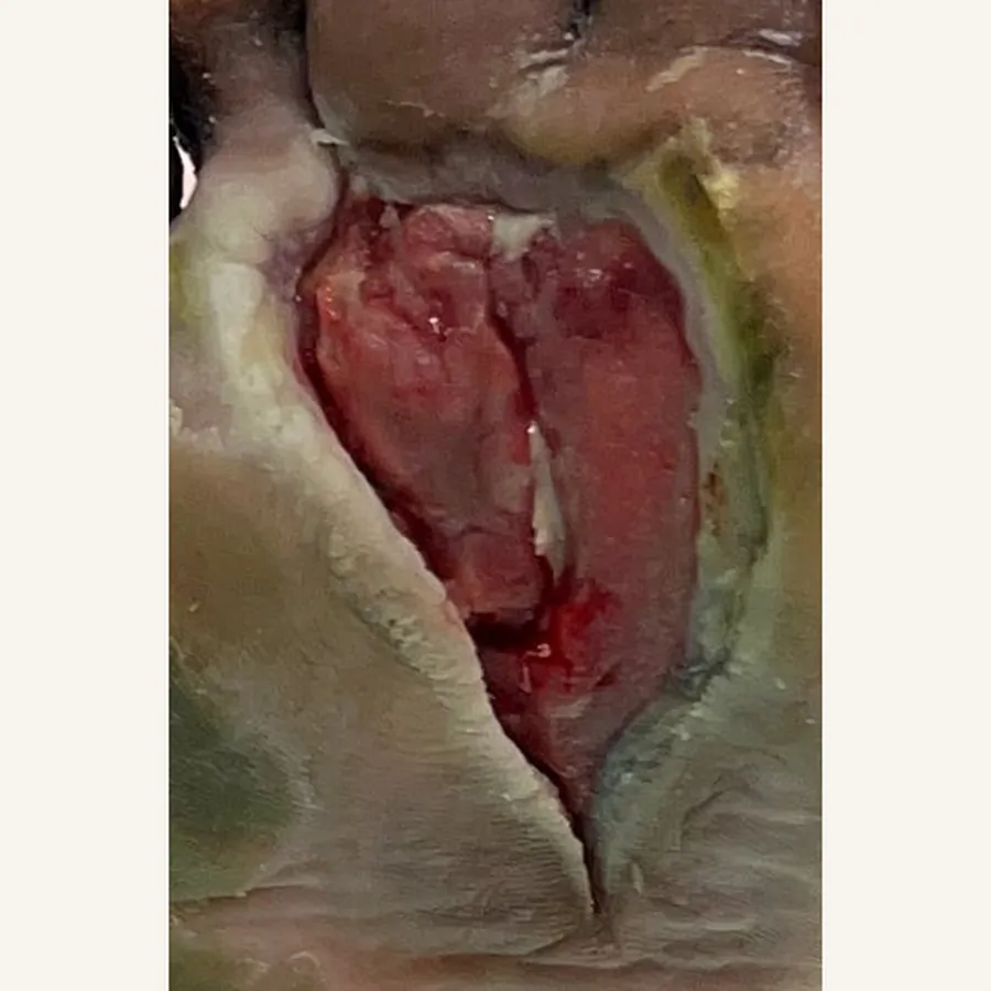 Clinical photograph of a diabetic plantar wound at visit 1, HKL-71