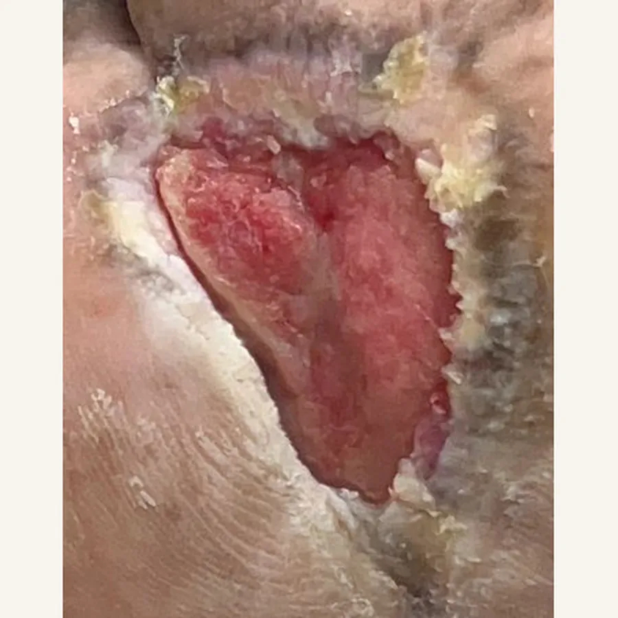 Clinical photograph of a diabetic plantar wound at visit 2, HKL-71