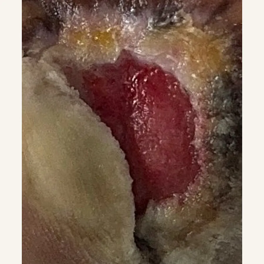 Clinical photograph of a diabetic plantar wound at visit 3, HKL-71
