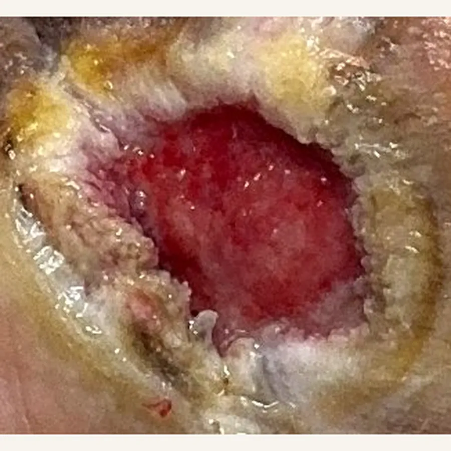 Clinical photograph of a diabetic plantar wound at visit 4, HKL-71