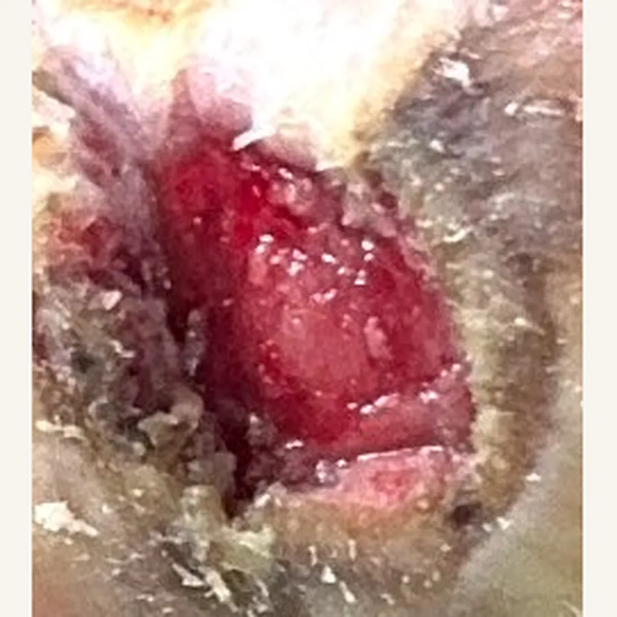 Clinical photograph of a diabetic plantar wound at visit 5, HKL-71