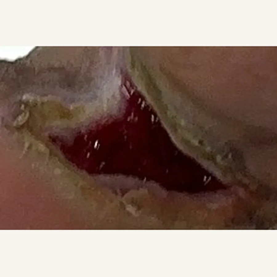 Clinical photograph of a diabetic foot wound at visit 1, HKL-72