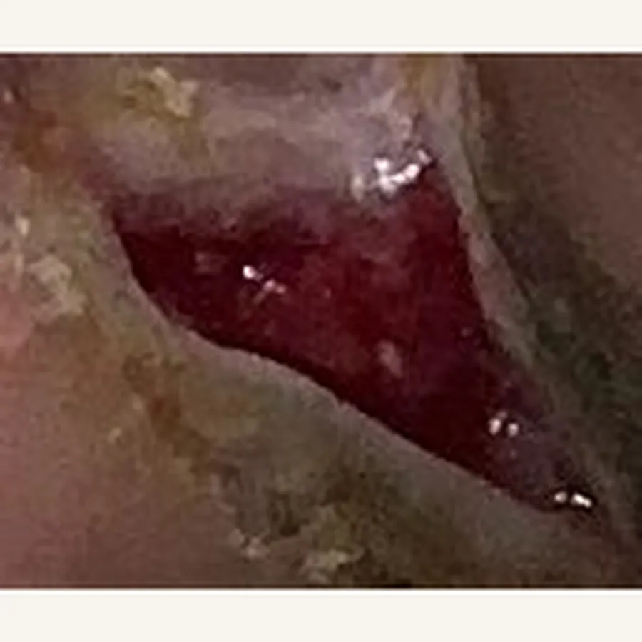 Clinical photograph of a diabetic foot wound at visit 2, HKL-72