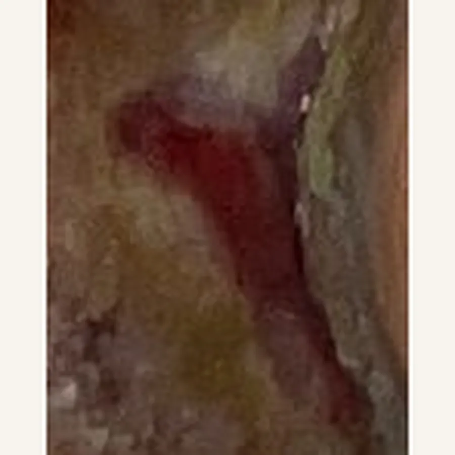Clinical photograph of a diabetic foot wound at visit 3, HKL-72