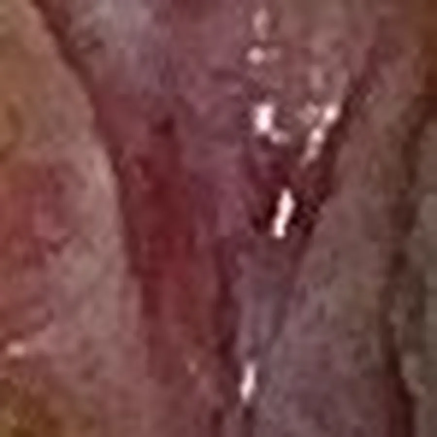 Clinical photograph of a diabetic foot wound at visit 4, HKL-72