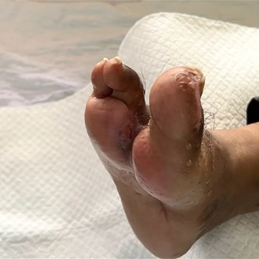 Clinical photograph of a diabetic foot wound at visit 5, HKL-72