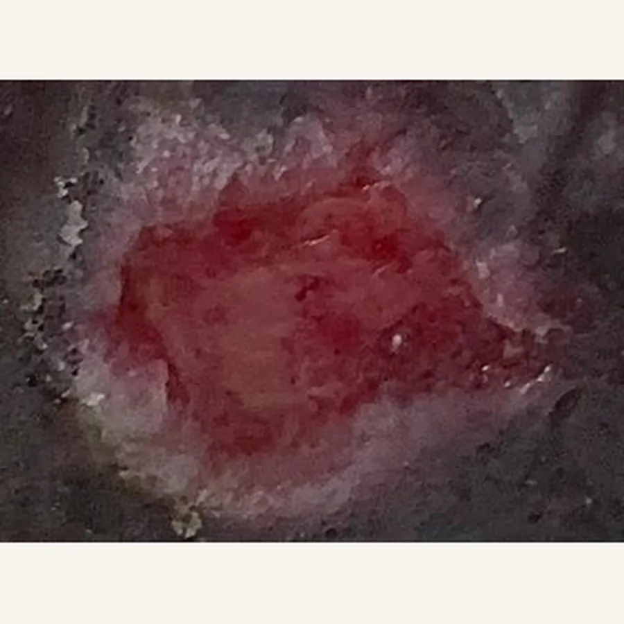 Clinical photograph of a diabetic foot wound at visit 1, HKL-73