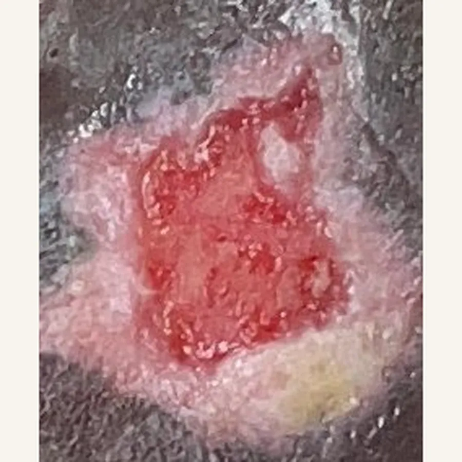 Clinical photograph of a diabetic foot wound at visit 2, HKL-73