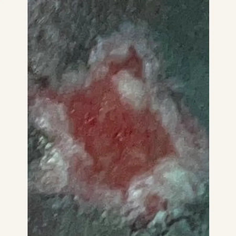 Clinical photograph of a diabetic foot wound at visit 3, HKL-73