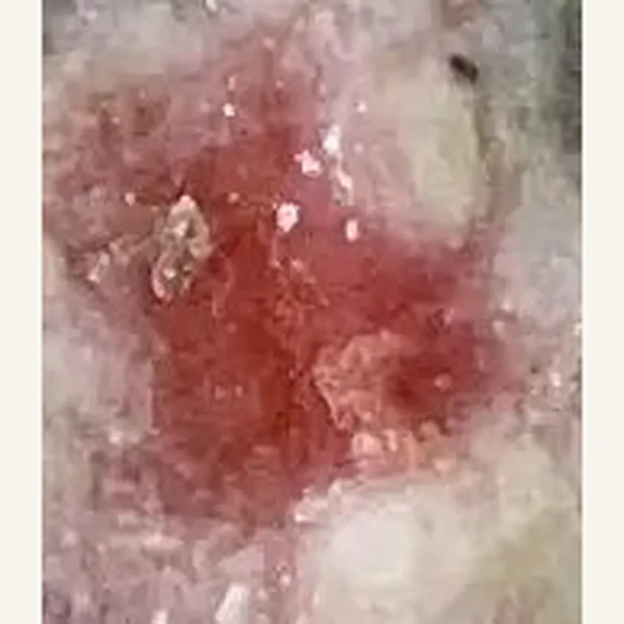 Clinical photograph of a diabetic foot wound at visit 4, HKL-73