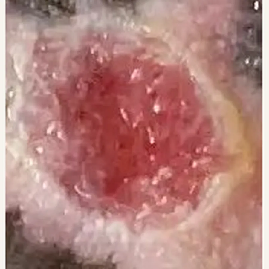 Clinical photograph of a diabetic foot wound at visit 5, HKL-73