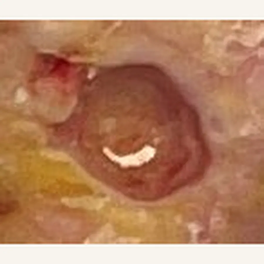 Clinical photograph of a diabetic foot wound at visit 1, HKL-74