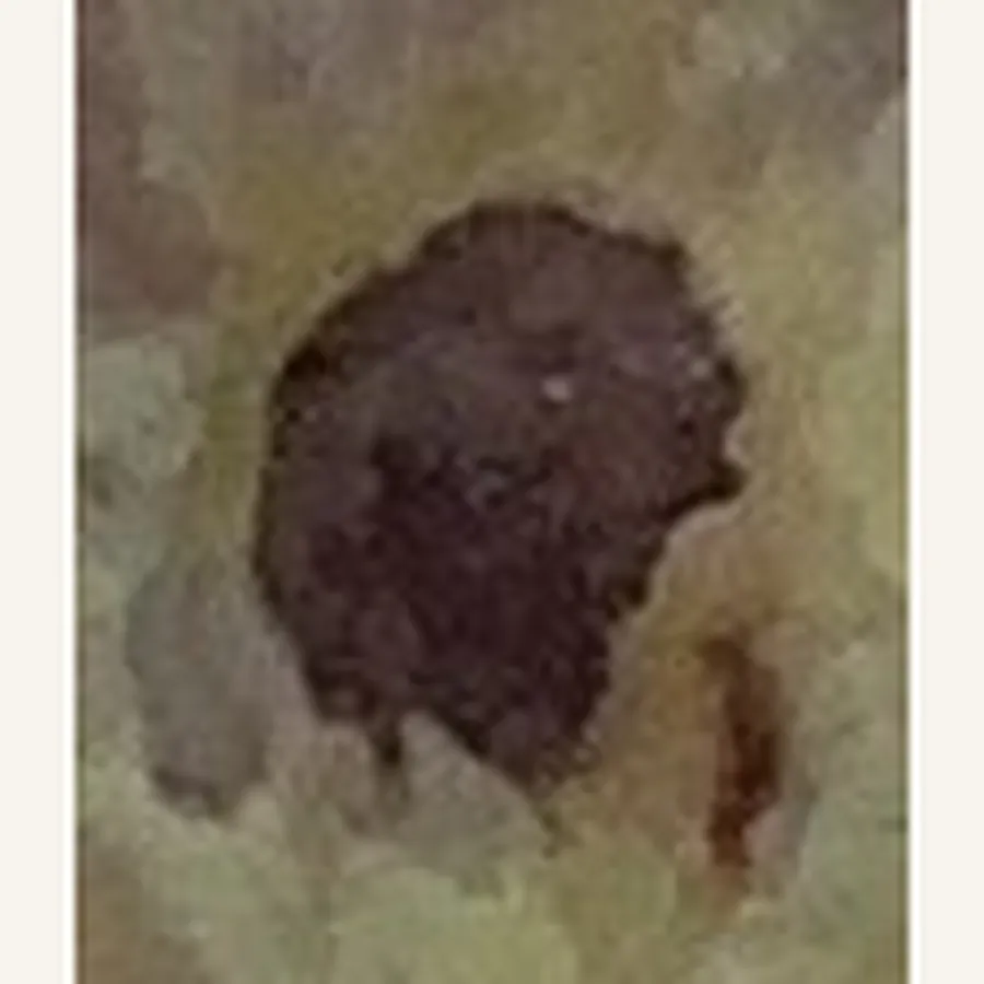 Clinical photograph of a diabetic foot wound at visit 2, HKL-74