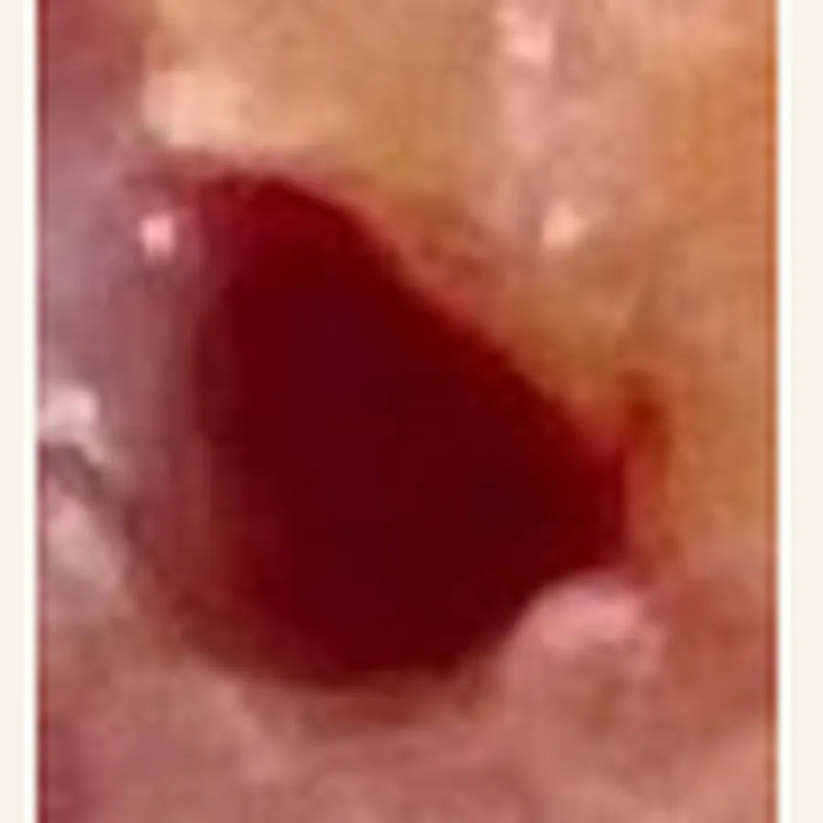 Clinical photograph of a diabetic foot wound at visit 3, HKL-74