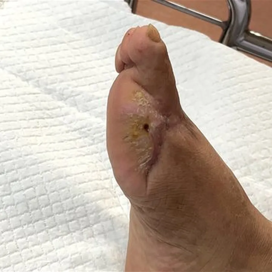 Clinical photograph of a diabetic foot wound at visit 4, HKL-74