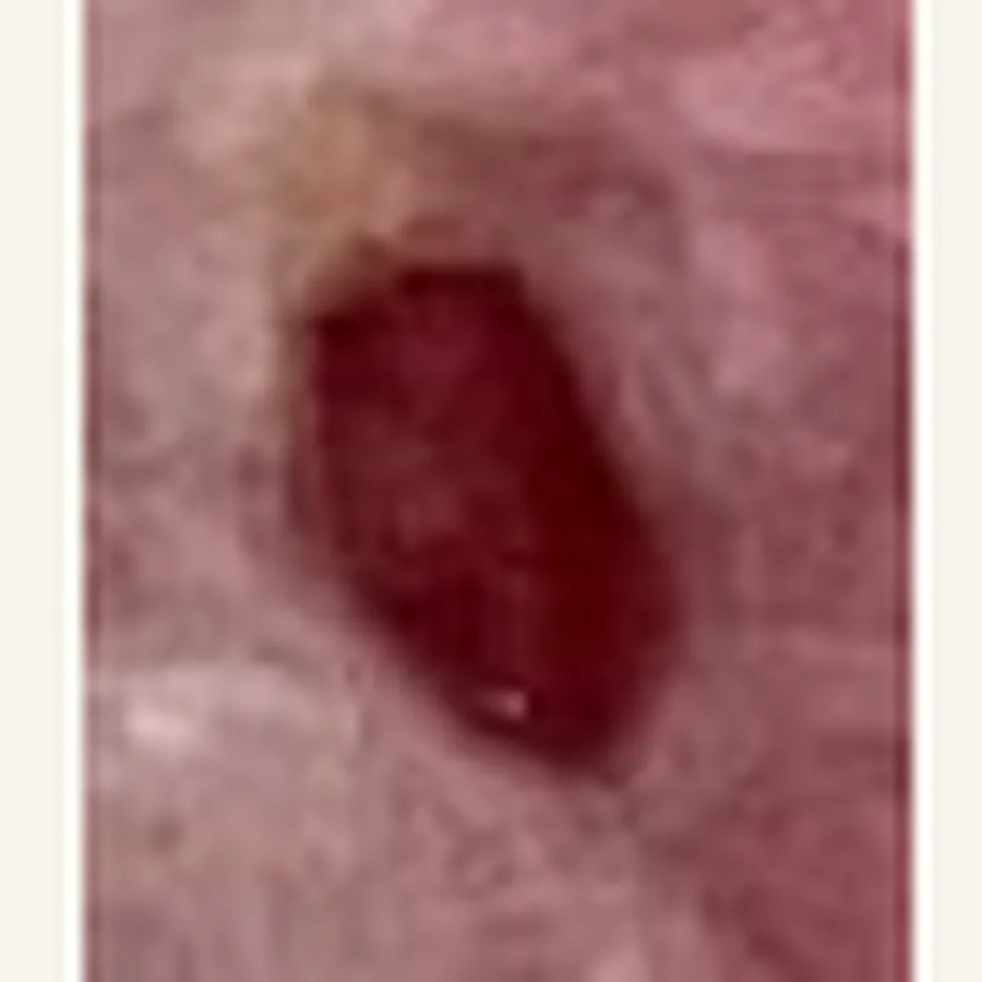 Clinical photograph of a diabetic foot wound at visit 5, HKL-74