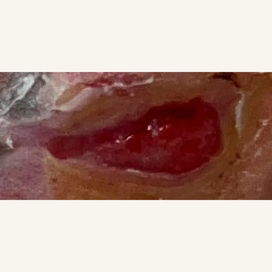 Clinical photograph of a diabetic plantar wound at visit 1, HKL-75