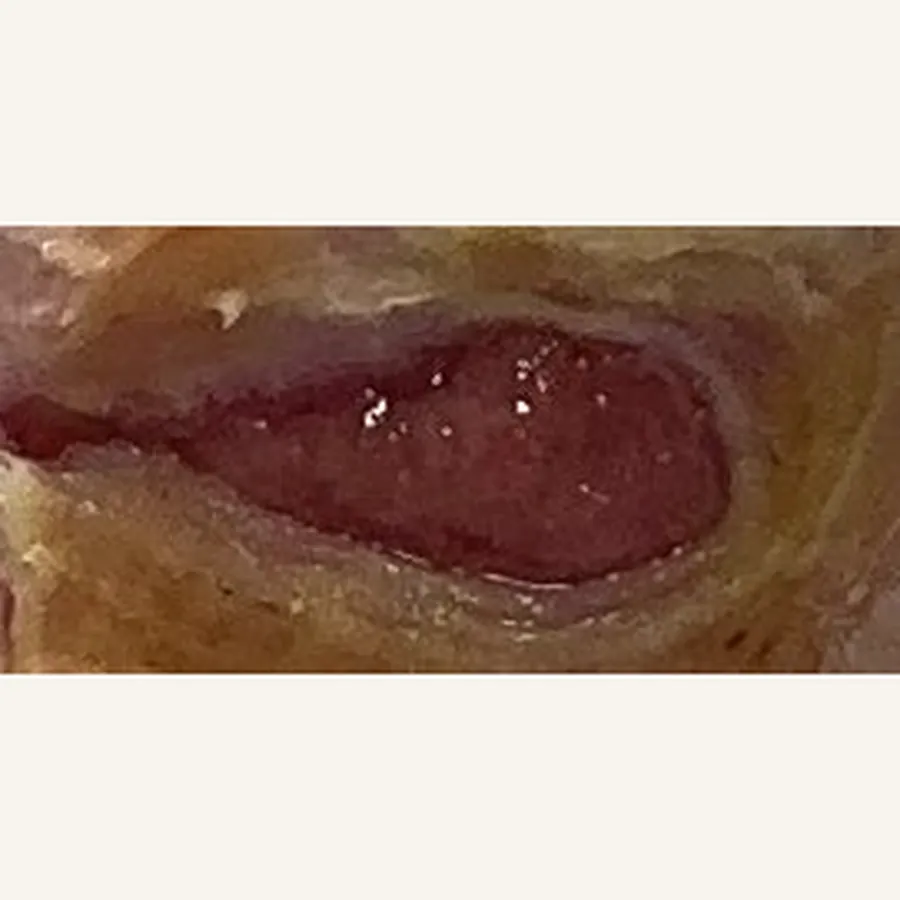 Clinical photograph of a diabetic plantar wound at visit 2, HKL-75