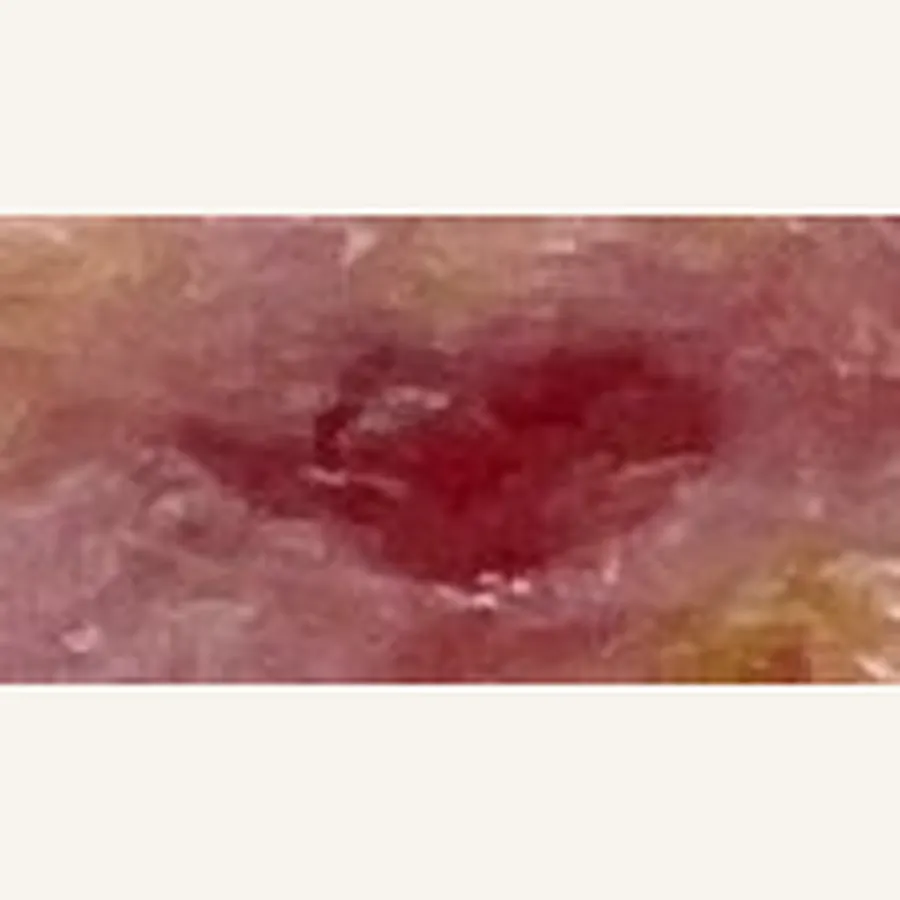 Clinical photograph of a diabetic plantar wound at visit 3, HKL-75