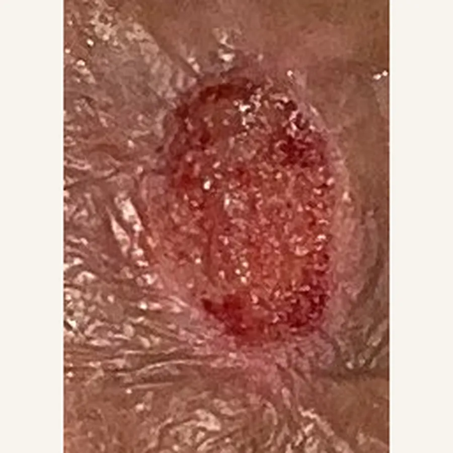 Clinical photograph of a lymphovascular foot wound at visit 1, HKL-76