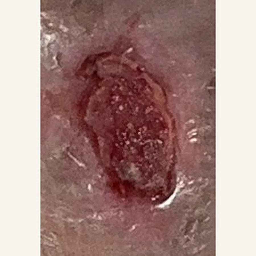 Clinical photograph of a lymphovascular foot wound at visit 2, HKL-76