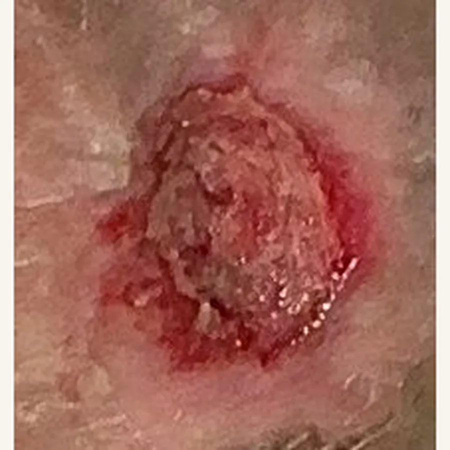 Clinical photograph of a lymphovascular foot wound at visit 3, HKL-76