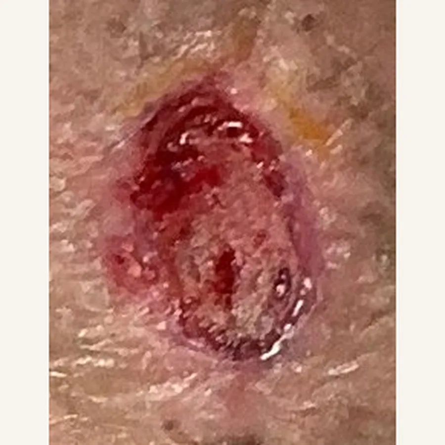 Clinical photograph of a lymphovascular foot wound at visit 4, HKL-76