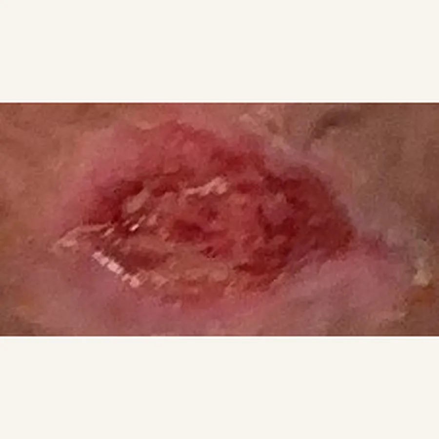 Clinical photograph of a lymphovascular foot wound at visit 5, HKL-76