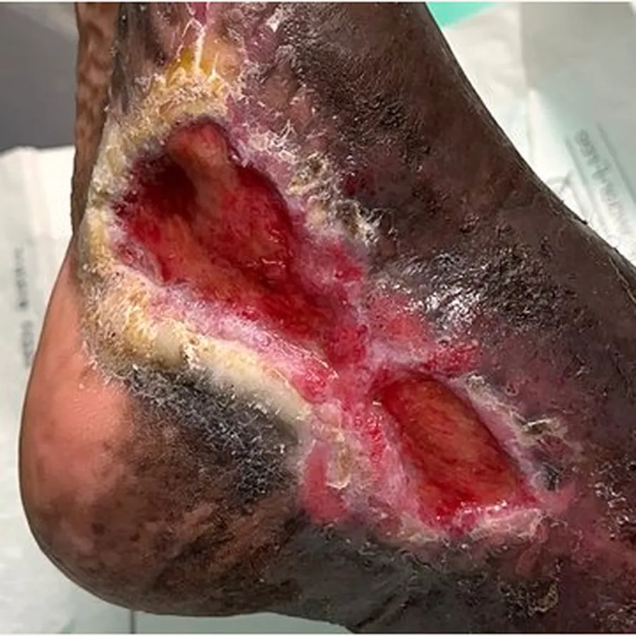 Clinical photograph of a diabetic foot wound at visit 1, HKL-77