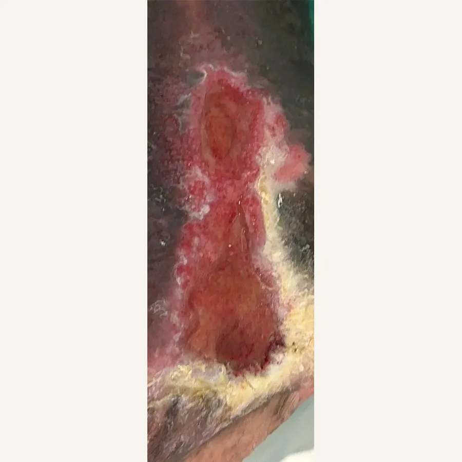 Clinical photograph of a diabetic foot wound at visit 2, HKL-77