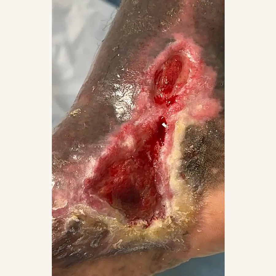 Clinical photograph of a diabetic foot wound at visit 3, HKL-77