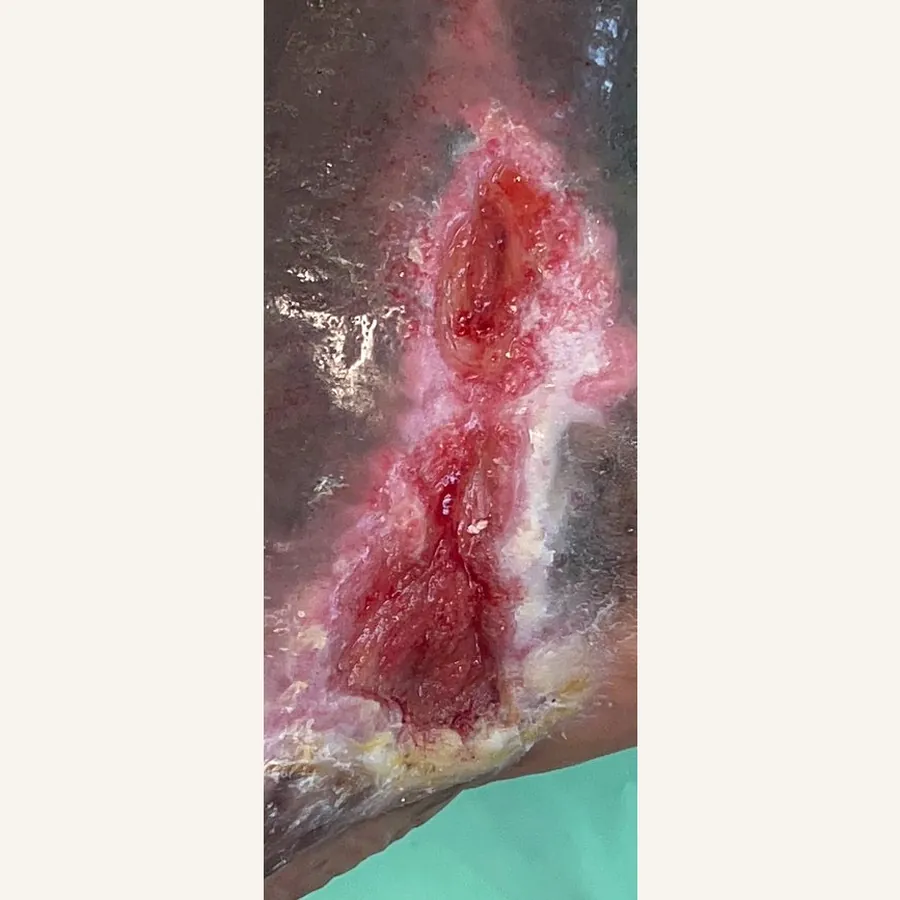 Clinical photograph of a diabetic foot wound at visit 4, HKL-77
